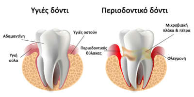 vector image tooth caries disease. Surface caries.Deep caries  Pulpitis Periodontitis.